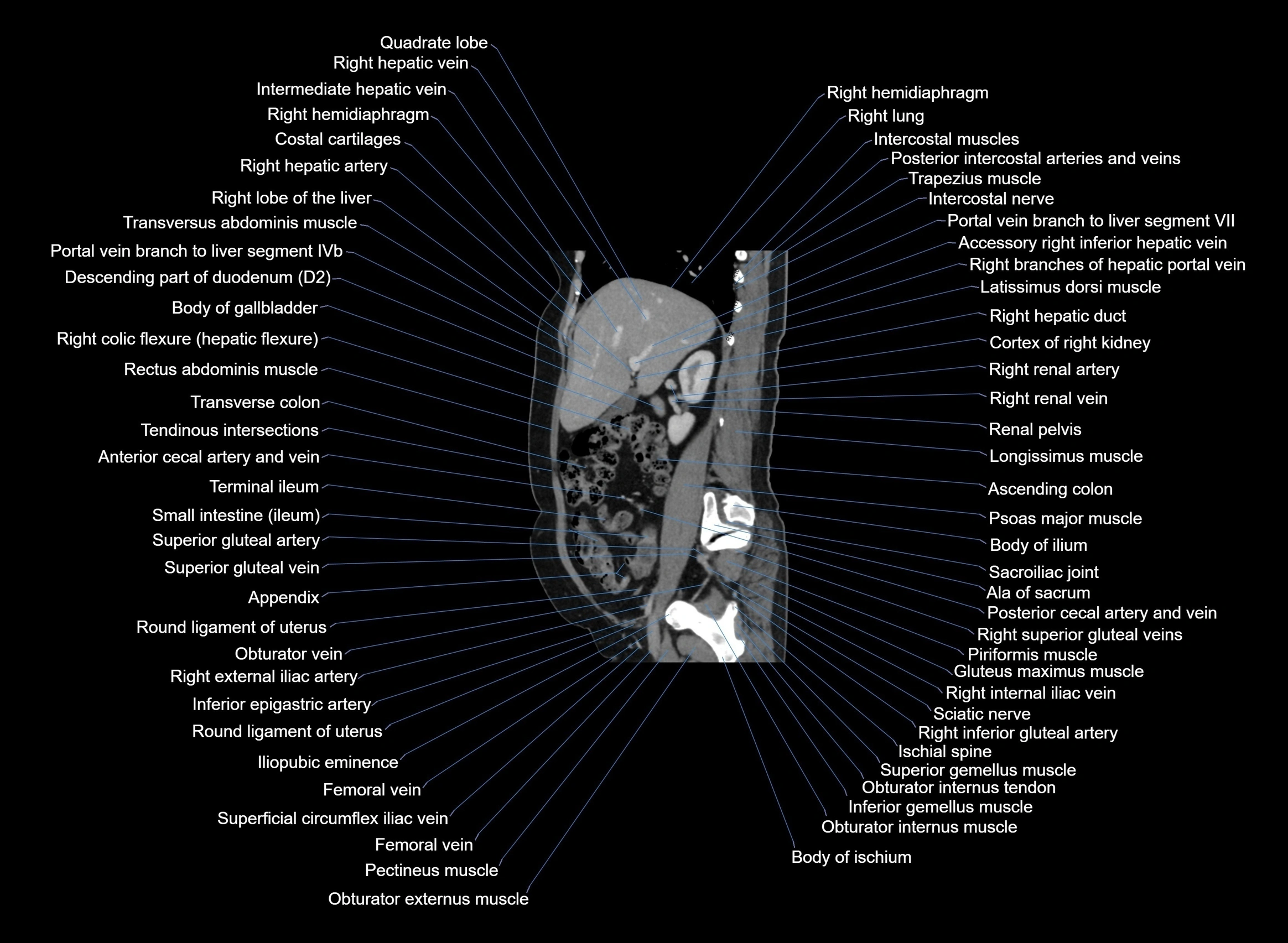 CT Abdomen sagittal cross sectional anatomy labelled radiology image -00076.webp
